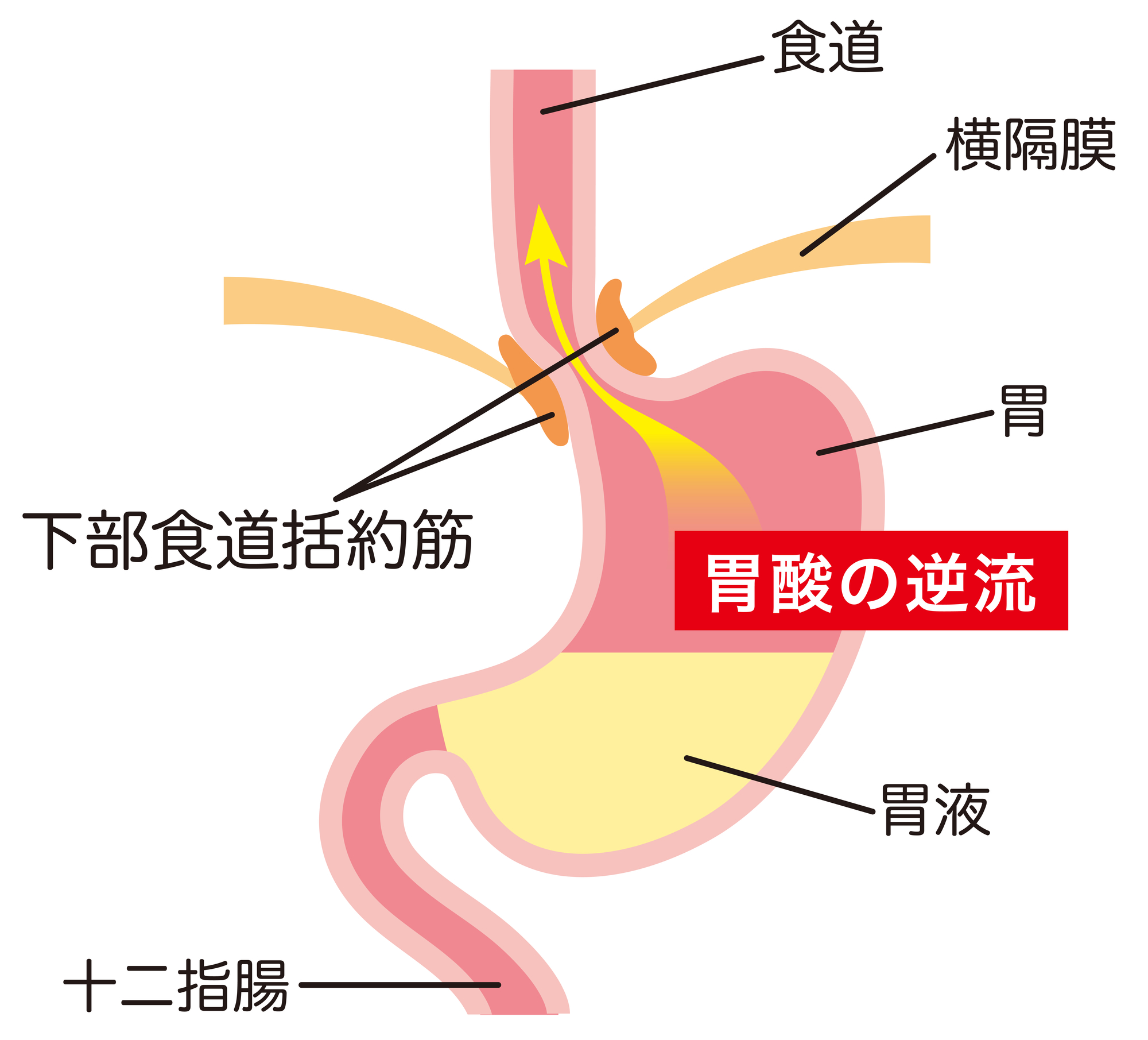 バレット食道｜北千住駅徒歩2分の消化器内科｜東京千住・胃と大腸の消化器内視鏡クリニック